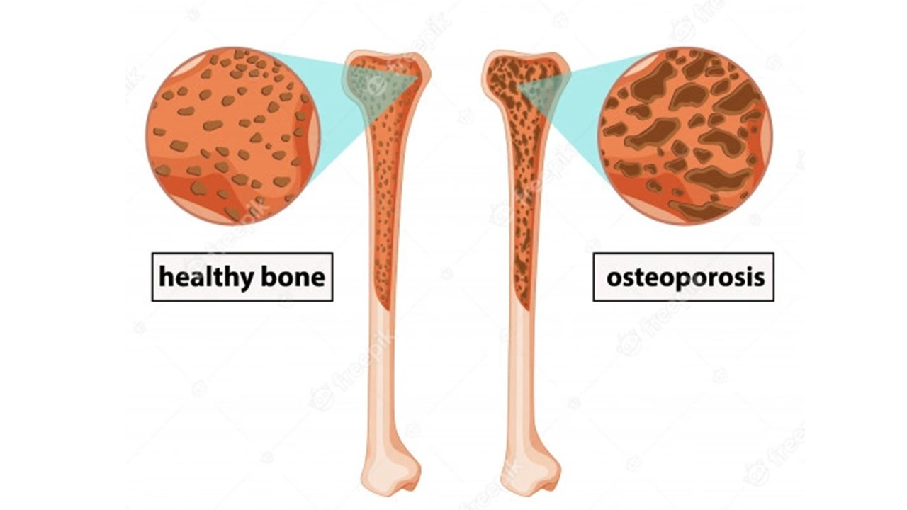 Penderita penyakit osteoporosis kemungkinan disebabkan kelebihan hormon